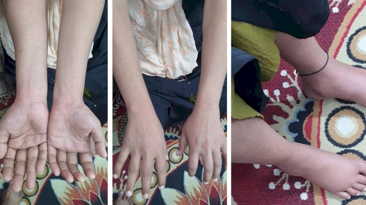 কক্সবাজারে অজানা ভাইরাসে বাড়ছে আতঙ্ক